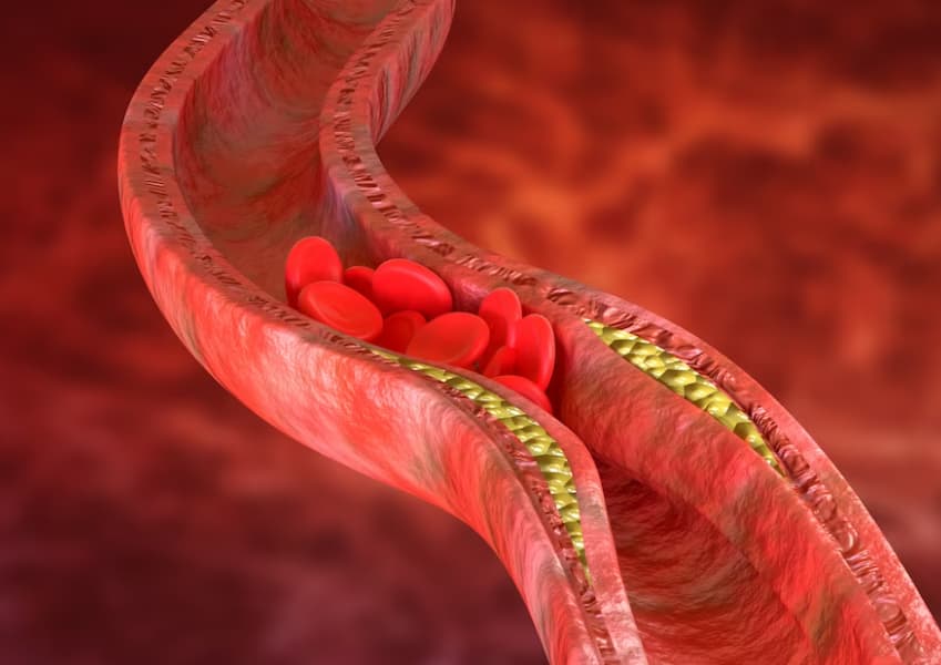 vena con piastrine che non passano a causa della malattia cardiovascolare